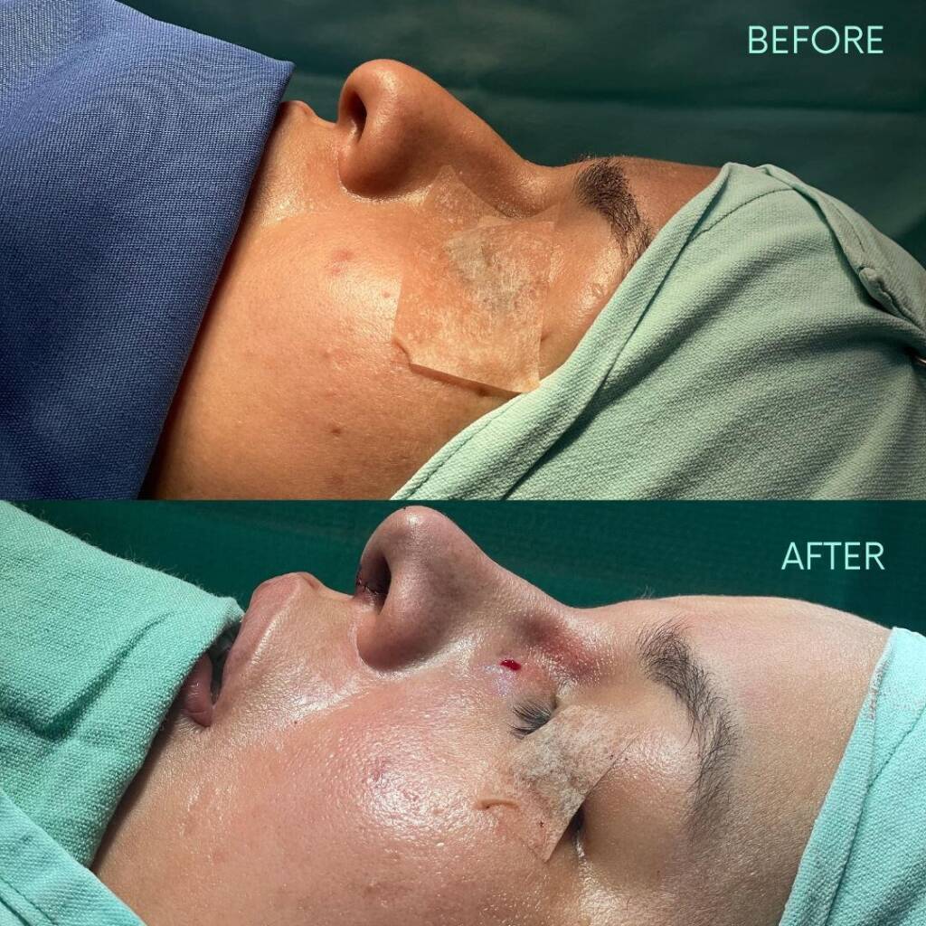 Fotografía del antes y después de un paciente de FYA que ha recibido una rinoplastia. Las imágenes muestran claramente la mejora estética y la transformación lograda a través de la cirugía, evidenciando la alta habilidad y la precisión de los cirujanos de FYA en la realización de procedimientos de cirugía plástica facial.