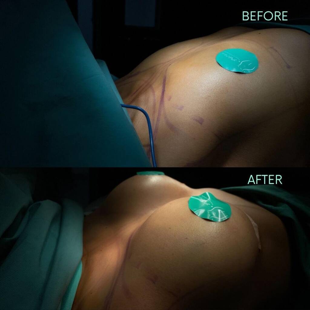 Fotografía del antes y después de un paciente de FYA que ha recibido implantes de senos. Las imágenes muestran claramente la mejora estética y la transformación alcanzada a través de la cirugía, resaltando la habilidad y la atención al detalle de los cirujanos de FYA en procedimientos de aumento y contorno corporal.